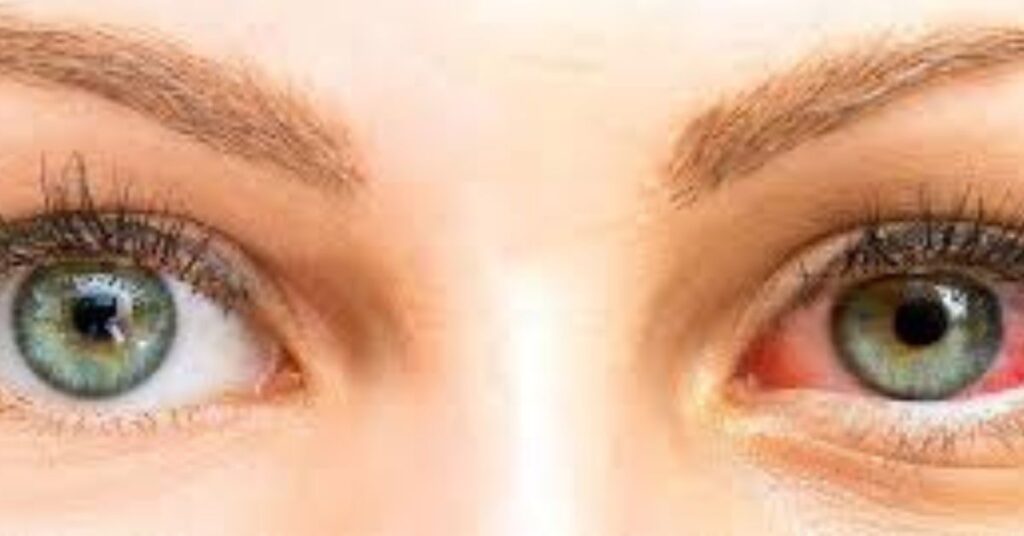 Dry Eye & Red Eye Treatment