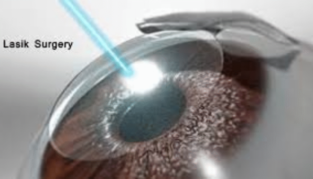 Lasik surgery correct your vision