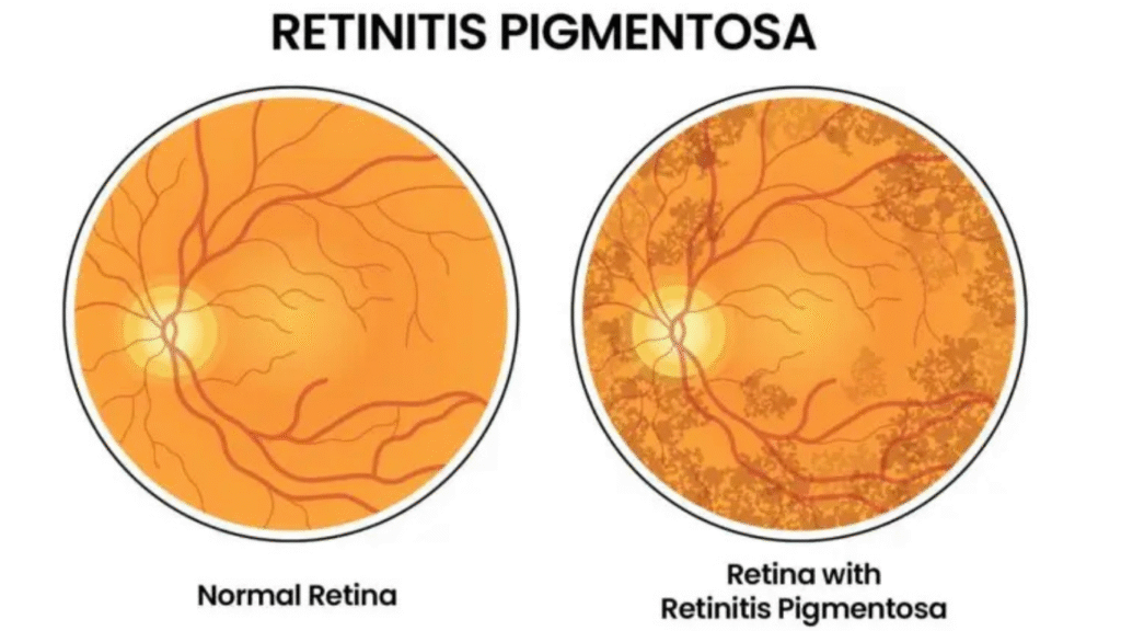 Retinitis Pigmentosa